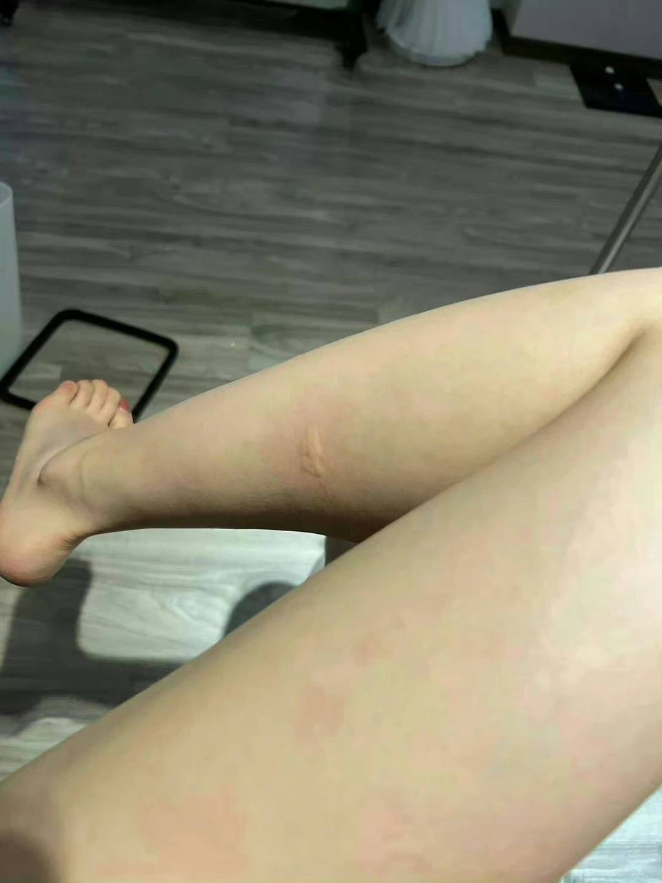 #身材 被蚊子咬了